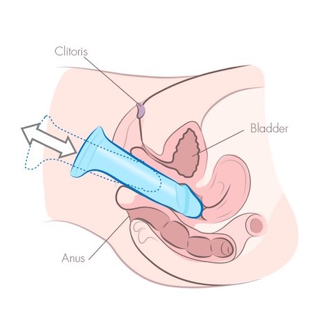 Diagrama mostrando o dildo em movimento de entrada e saída ao longo de toda a vagina